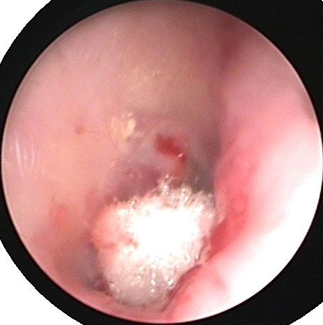 耳内镜鼓膜修补术 - 好大夫在线