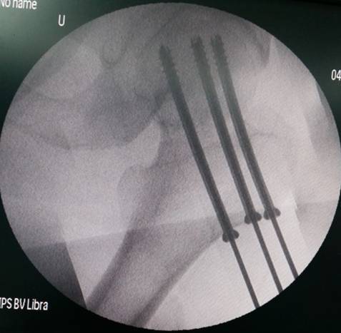股骨頸骨折閉合復位內固定