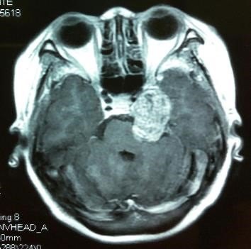 巨大中后颅窝沟通哑铃型三叉神经鞘瘤的手术治