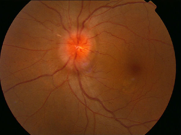 压迫性视神经病变