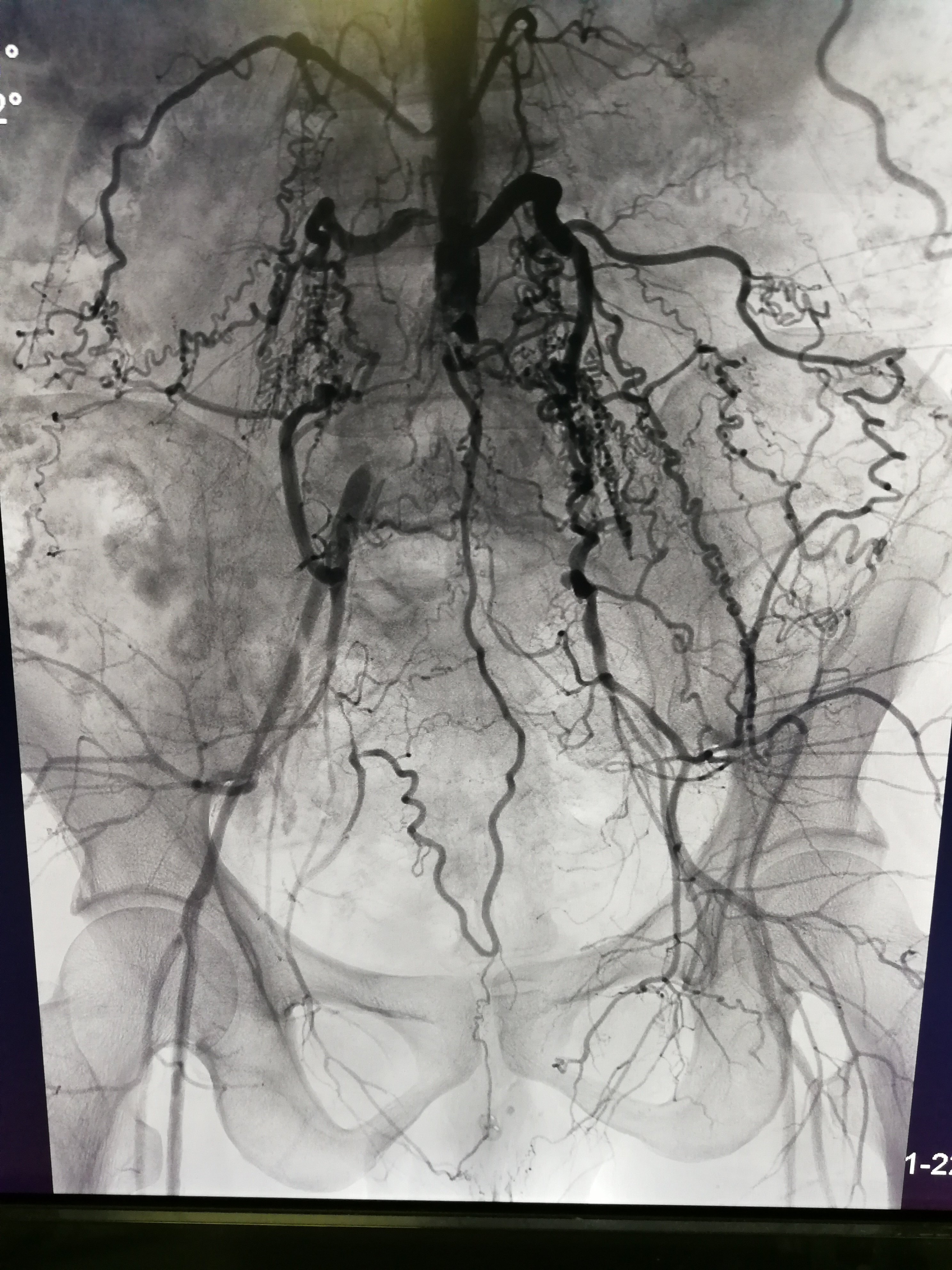 主髂动脉闭塞症微创治疗