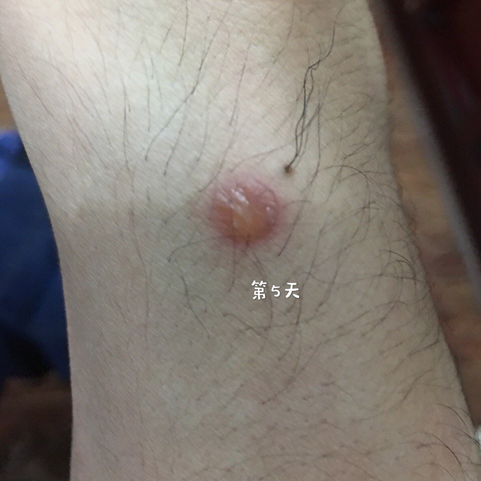 手部浅度烫伤的皮肤1个月变化过程 手部浅度烫伤的皮肤1个月变化过程
