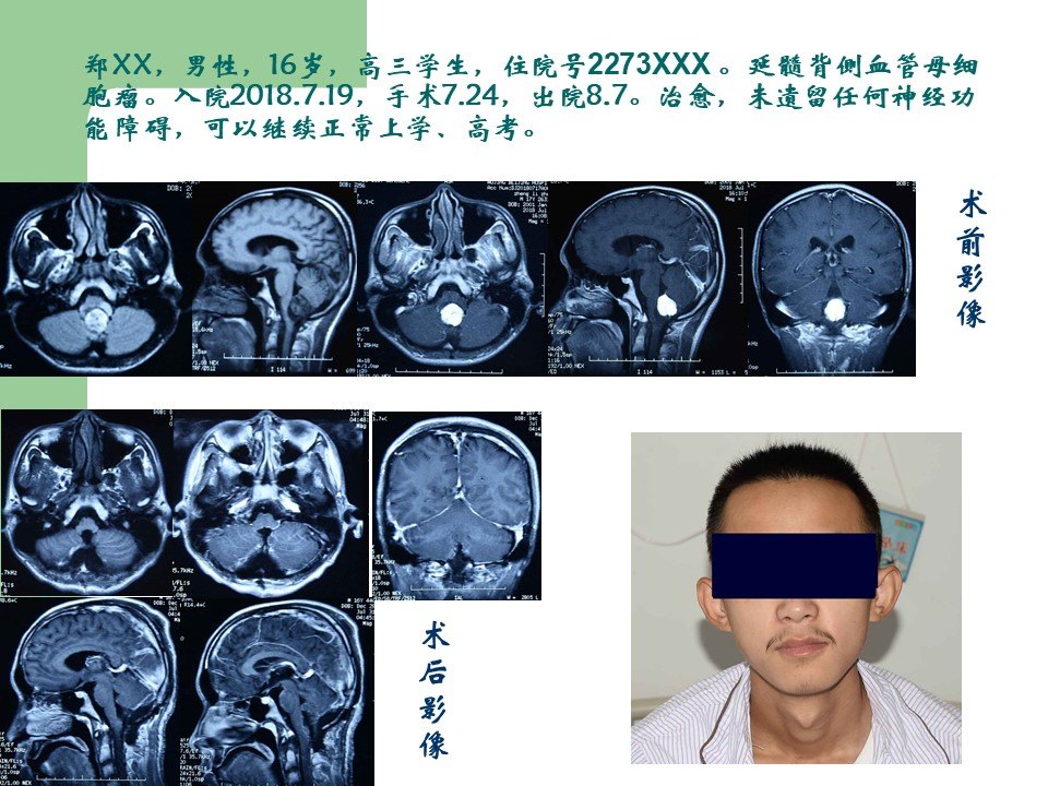 延髓血管瘤图片