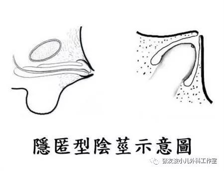 害羞的 小蜗牛 男孩外生殖器疾病之 隐匿性阴茎 男性生殖器畸形 疾病介绍 害羞的 小蜗牛 男孩外生殖器疾病之 隐匿性阴茎 男性生殖器畸形 疾病介绍