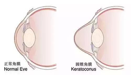 要警惕圆锥角膜! (原创)