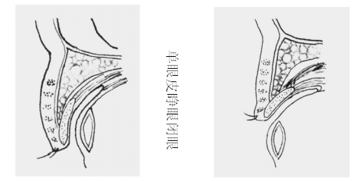 单眼皮原理_副本.png