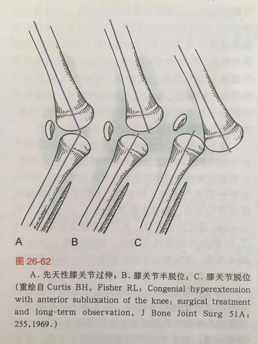 先天性膝关节反屈图片图片