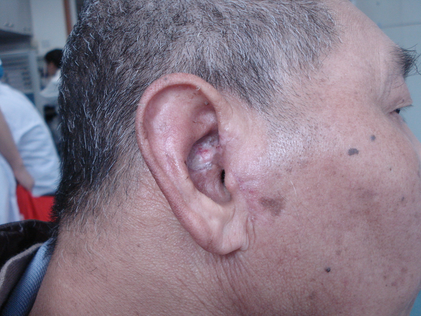 外耳道腺样囊性癌图片图片