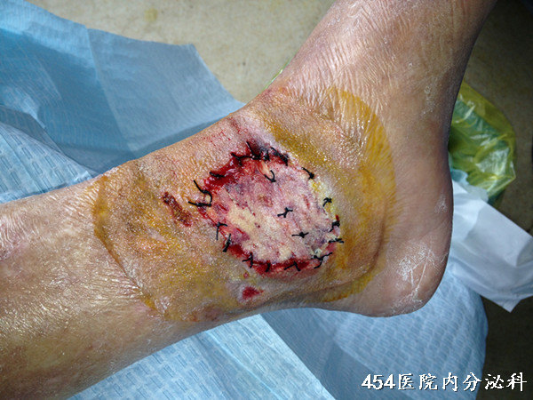 左踝关节破溃1年治愈