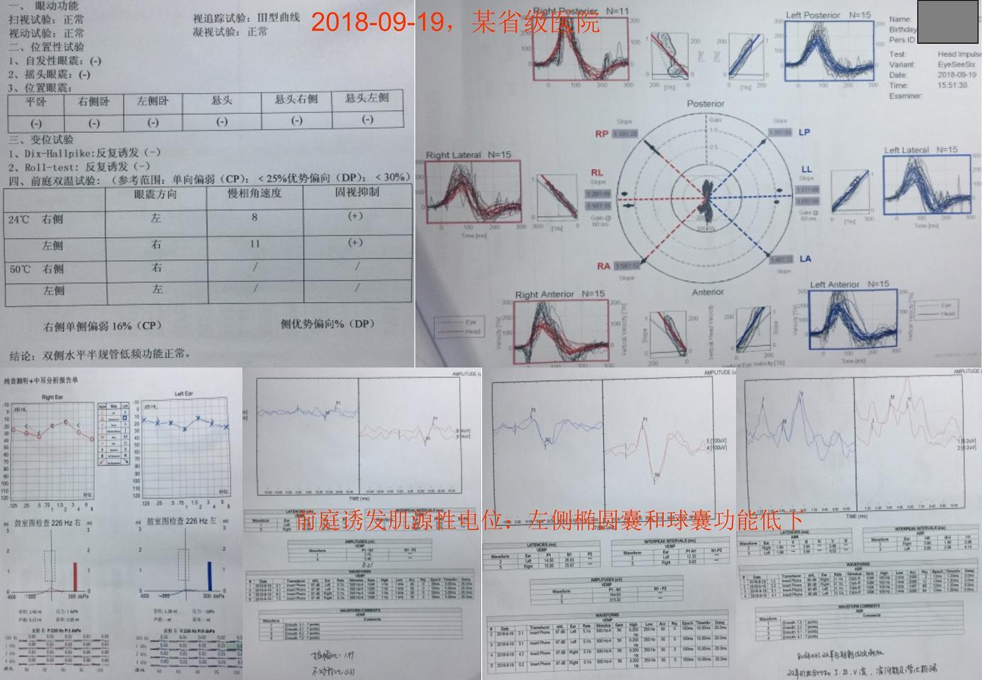 眼震电图报告图片