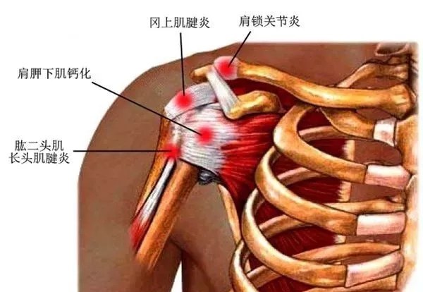 肩周炎位置示意图图片