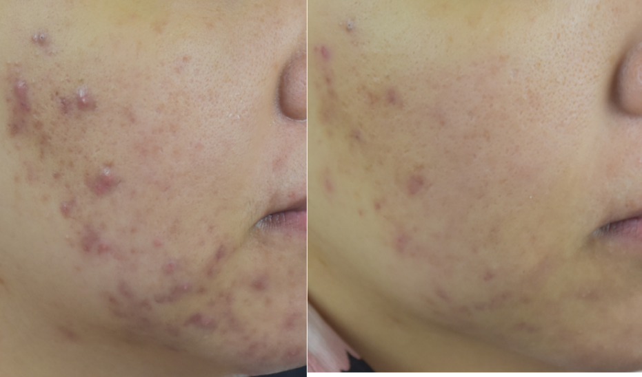 "战痘"日记(三) --脸上有了痘印痘坑,好难看!怎么办 (原创)