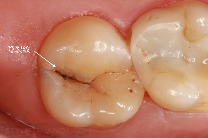 隐裂牙是指表面有细小裂纹的牙齿.