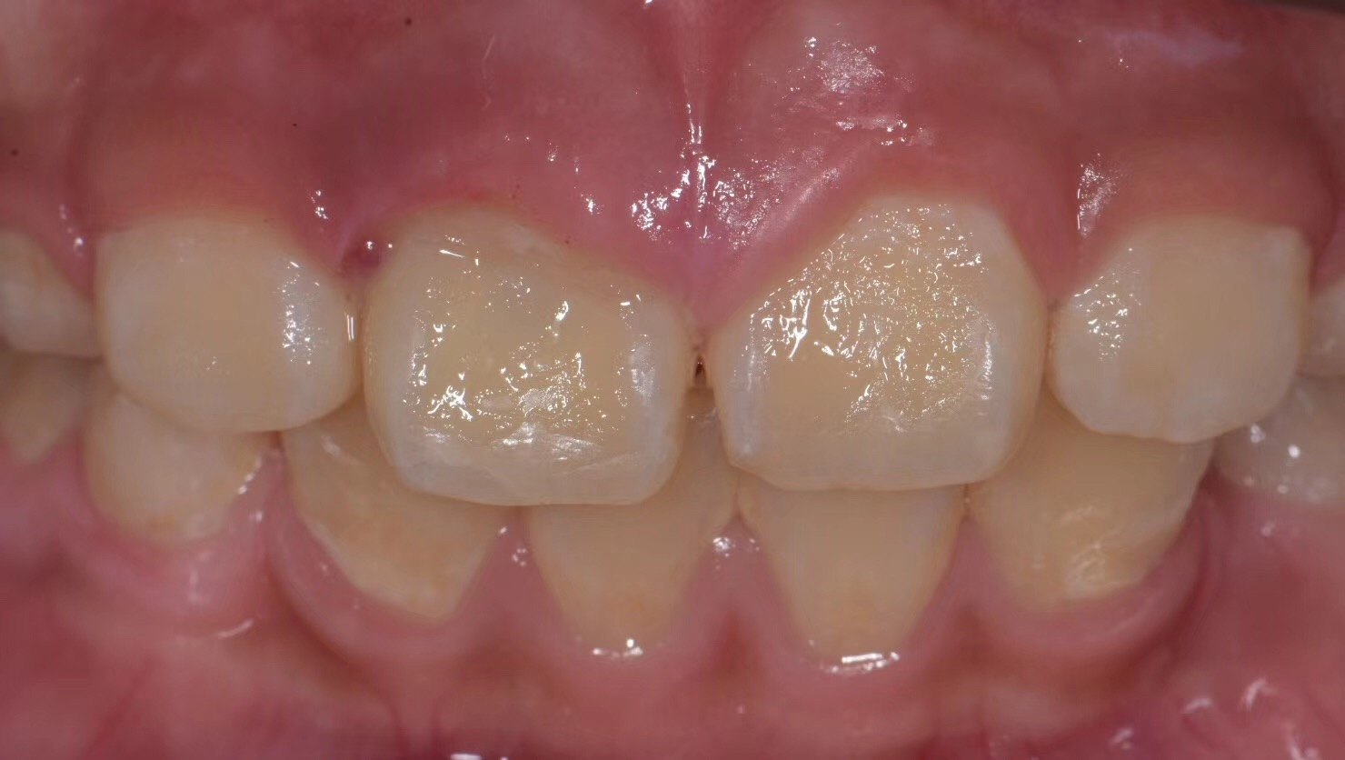 外伤牙断牙再接 - 好大夫在线