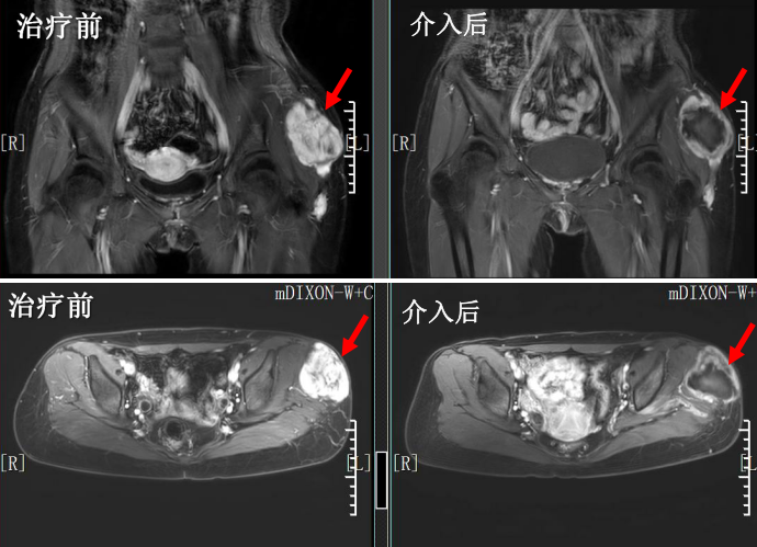 骨與軟組織肉瘤經動脈化療栓塞tace介入治療