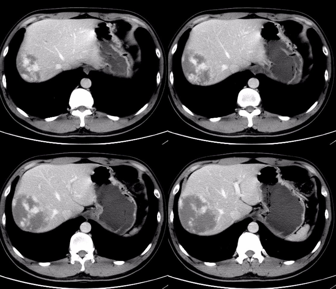 E诊断：肝脏部位CT诊断笔记-搜狐