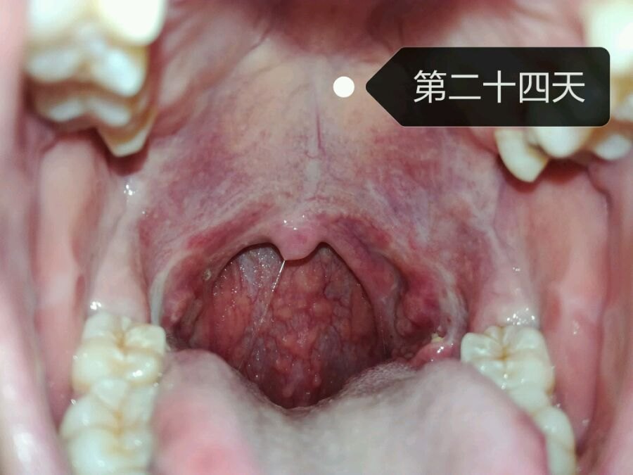 大家注意啰,扁桃体窝下极开始被舌根的淋巴滤泡占据了还有斑点还有一