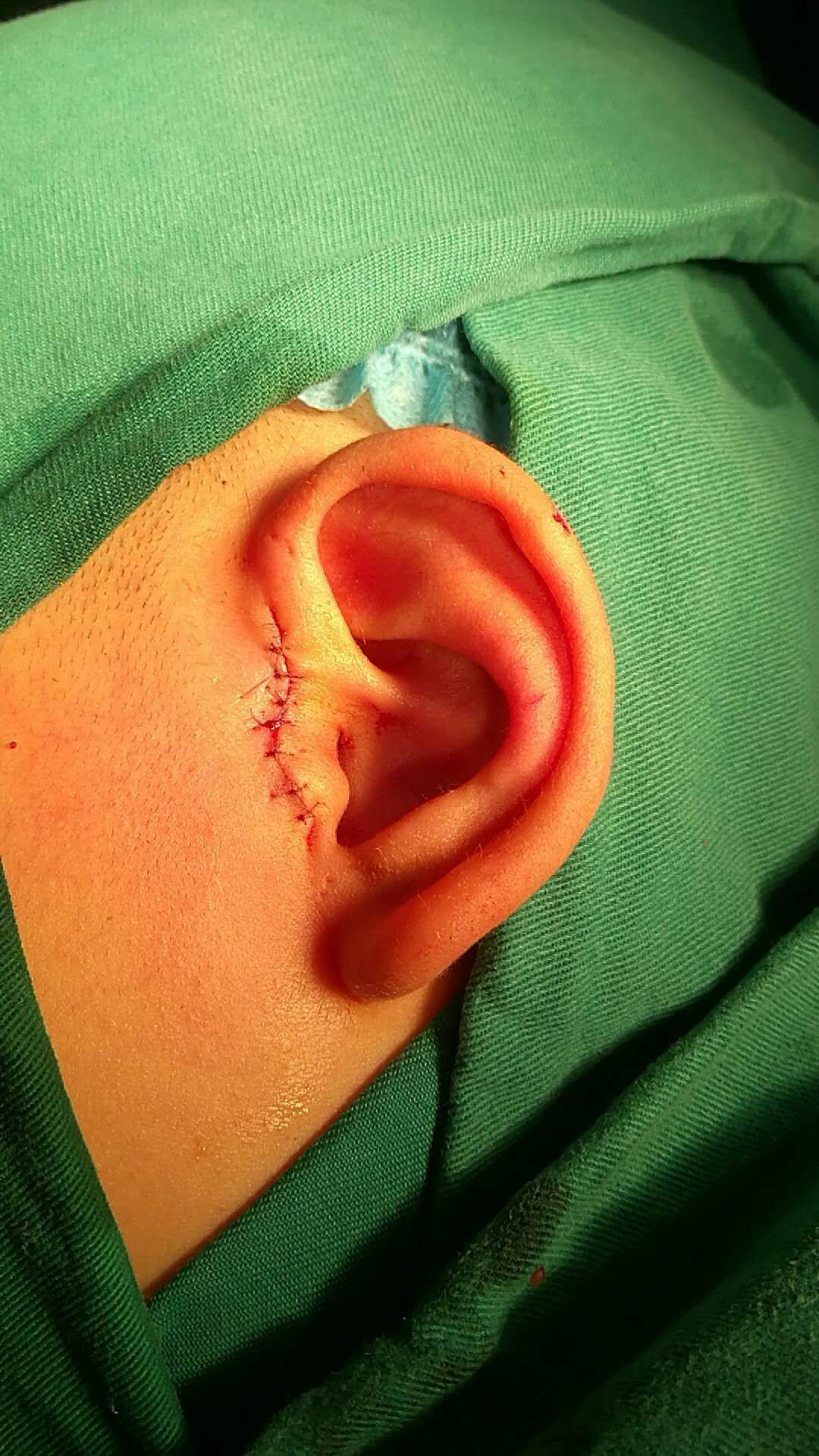 耳朵仓眼手术后照片图片