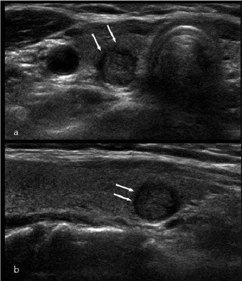 内部回声均匀(如图1),网状或蜂窝状,彗星尾征等,而恶性甲状腺结