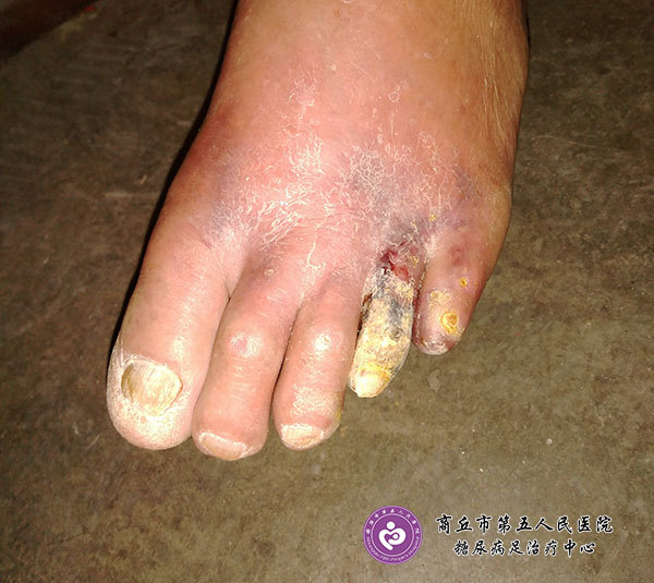 糖尿病并发症肾功能异常和糖尿病足坏脚怎么治