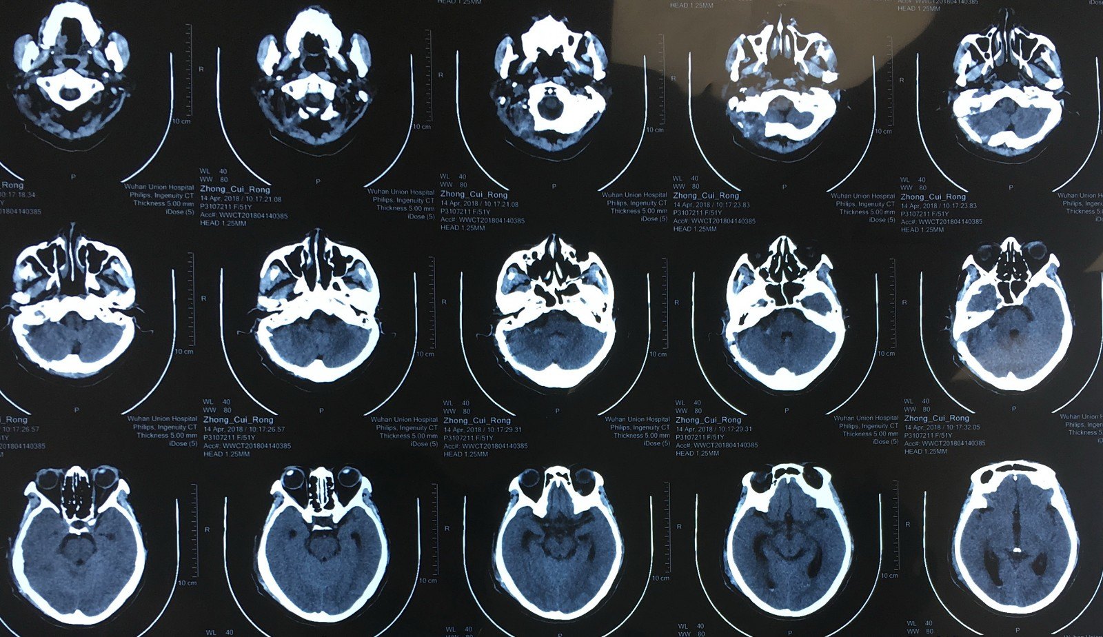 开心的笑容--大型听神经瘤(3期)手术痊愈出院