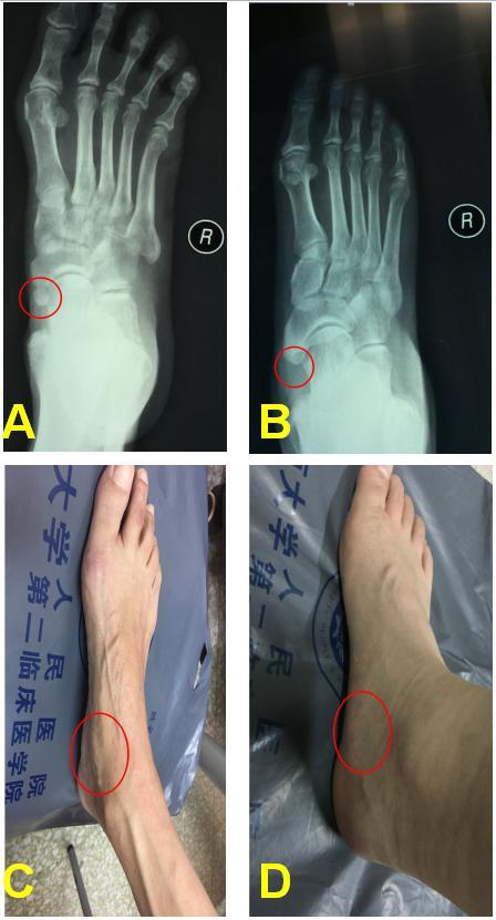 足的副舟骨是什么梗 看完这篇文章就全明白了 先天性足畸形 疾病介绍 治疗方法 足的副舟骨是什么梗 看完这篇文章就全明白了 先天性足畸形 疾病介绍 治疗方法