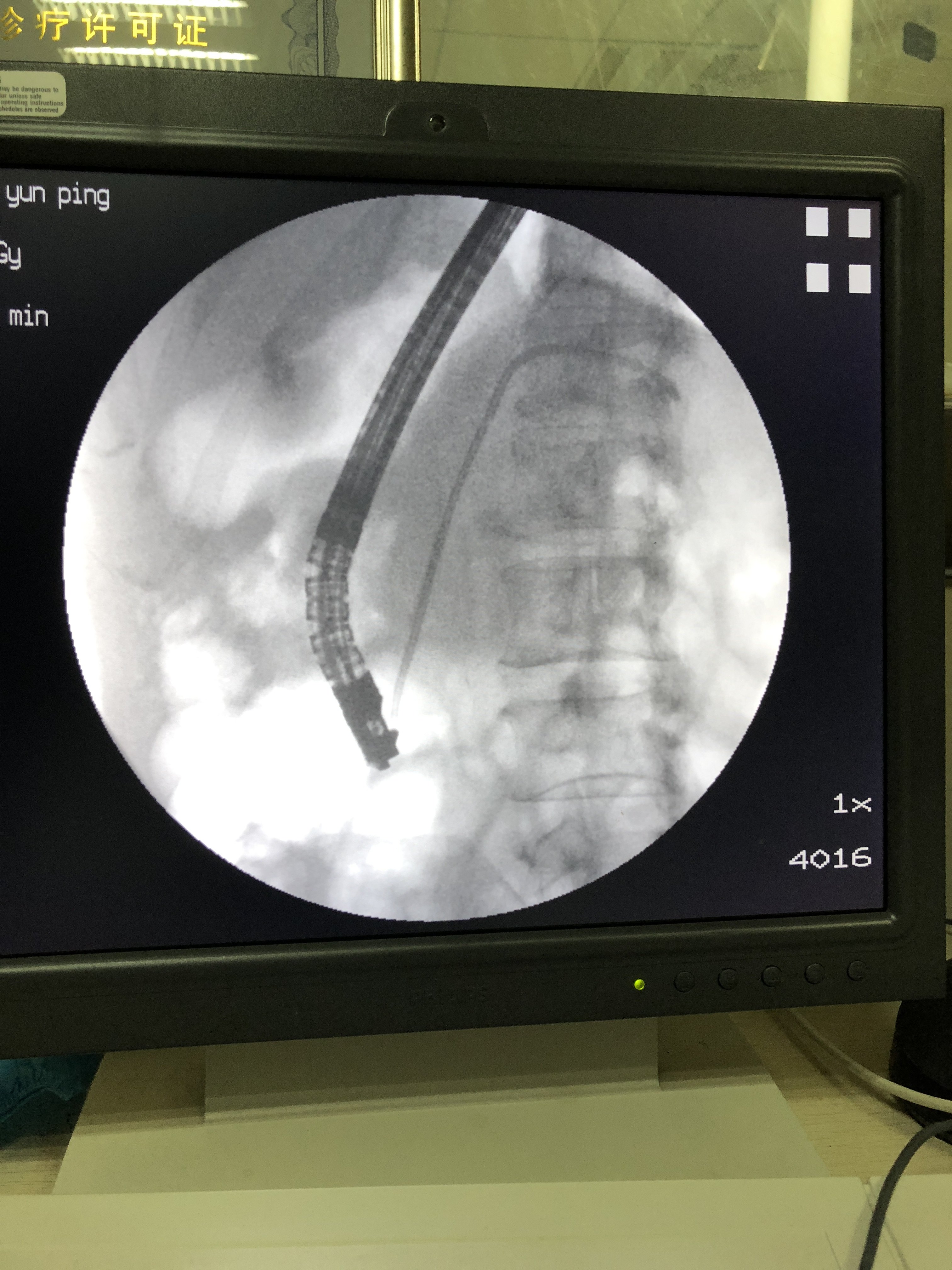 胰管放支架图片