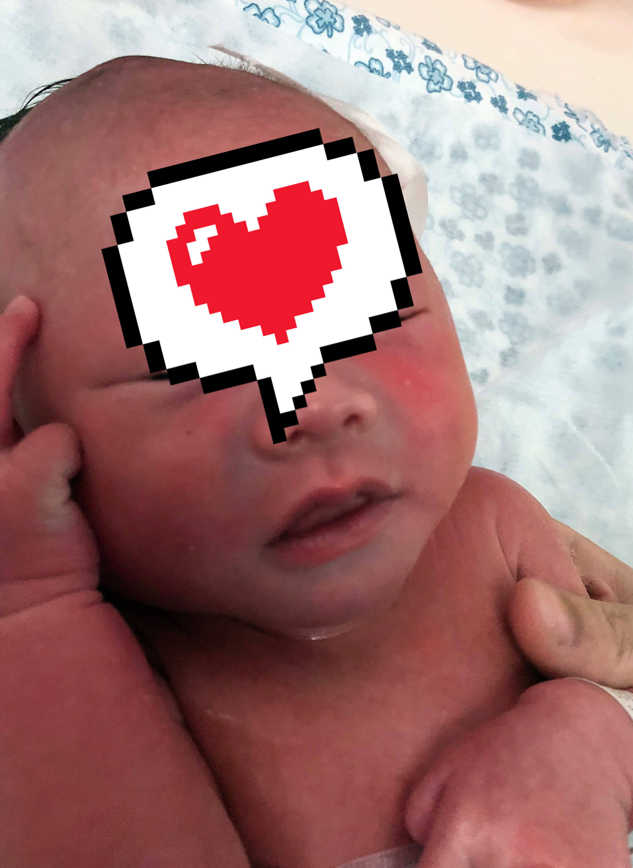 产前双侧胸腔积液-顺利回家咯