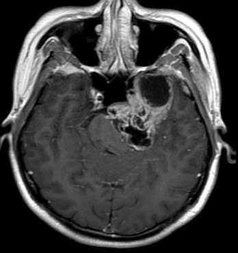 巨大中后颅窝沟通哑铃型三叉神经鞘瘤的手术治
