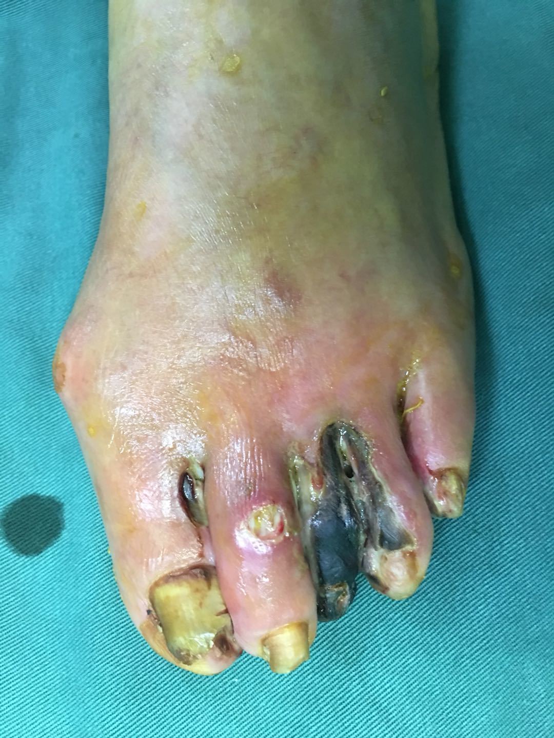 科普时间 糖尿病足～ "左下肢动脉硬化闭塞症,糖尿病足" - 好大夫在线