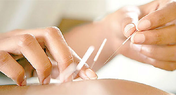 穴位埋线减肥是在针刺基础上发展起来的,是经络理论与现代物理医学相