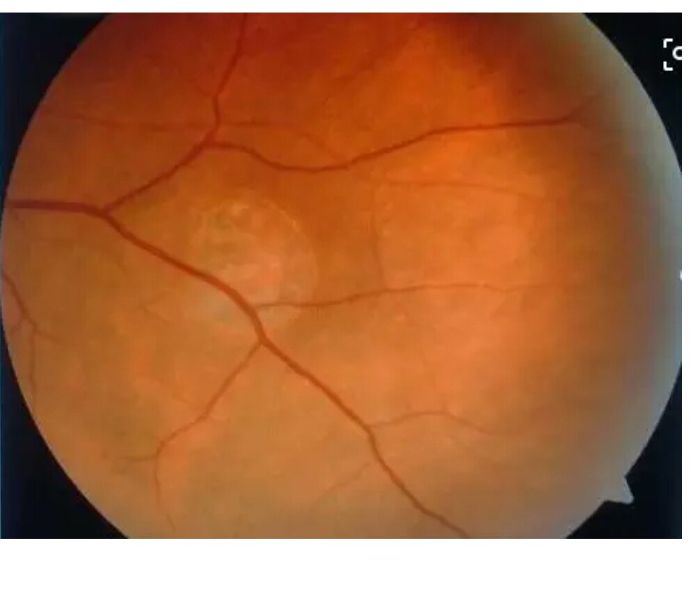 高度近视并发症之一:视网膜脱离 