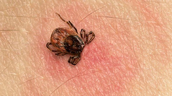 tick-bites-in-children-722x406.jpg