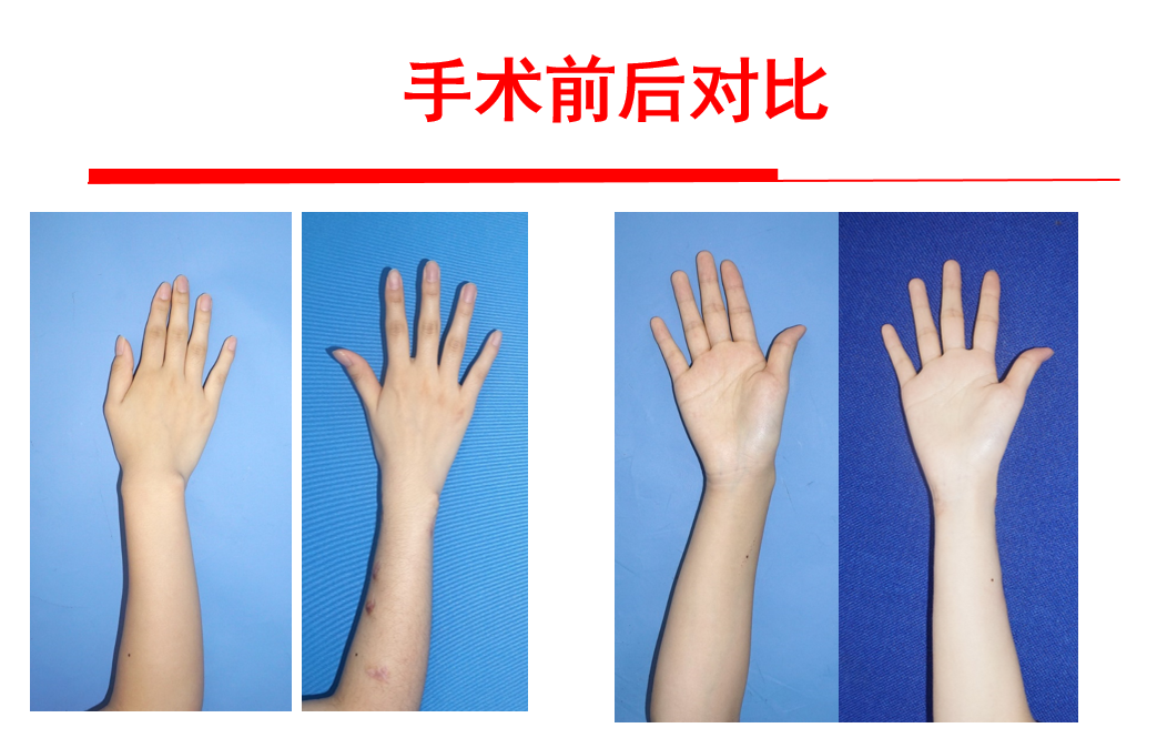 马德隆畸形治疗再获新突破—上海六院骨科康庆林矫形团队