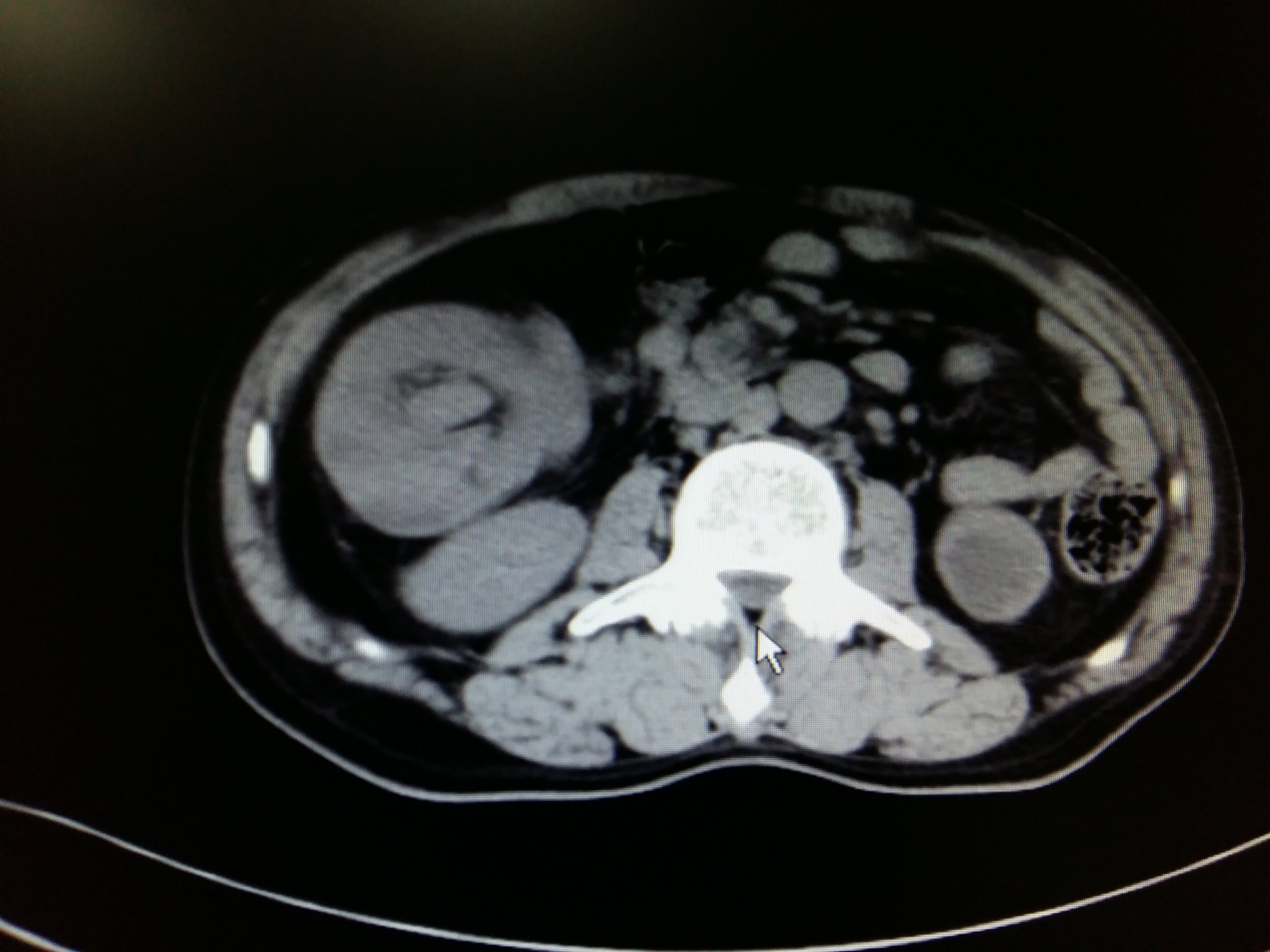 结肠癌ct表现图片图片