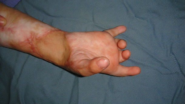 上肢瘢痕挛缩畸形 - 好大夫在线