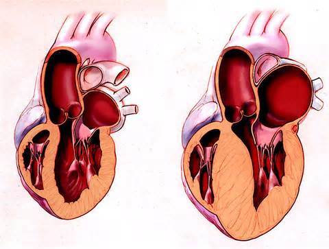 什么是肥厚型心肌病?可怕吗?