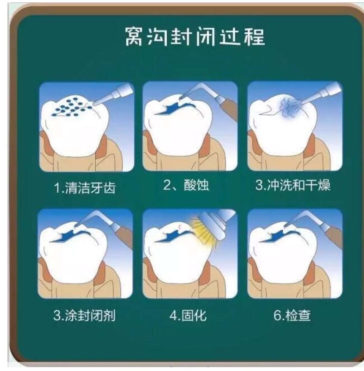 儿童乳牙窝沟封闭和涂氟