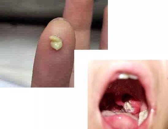 藏在扁桃体里的小石头 好大夫在线 藏在扁桃体里的小石头 好大夫在线