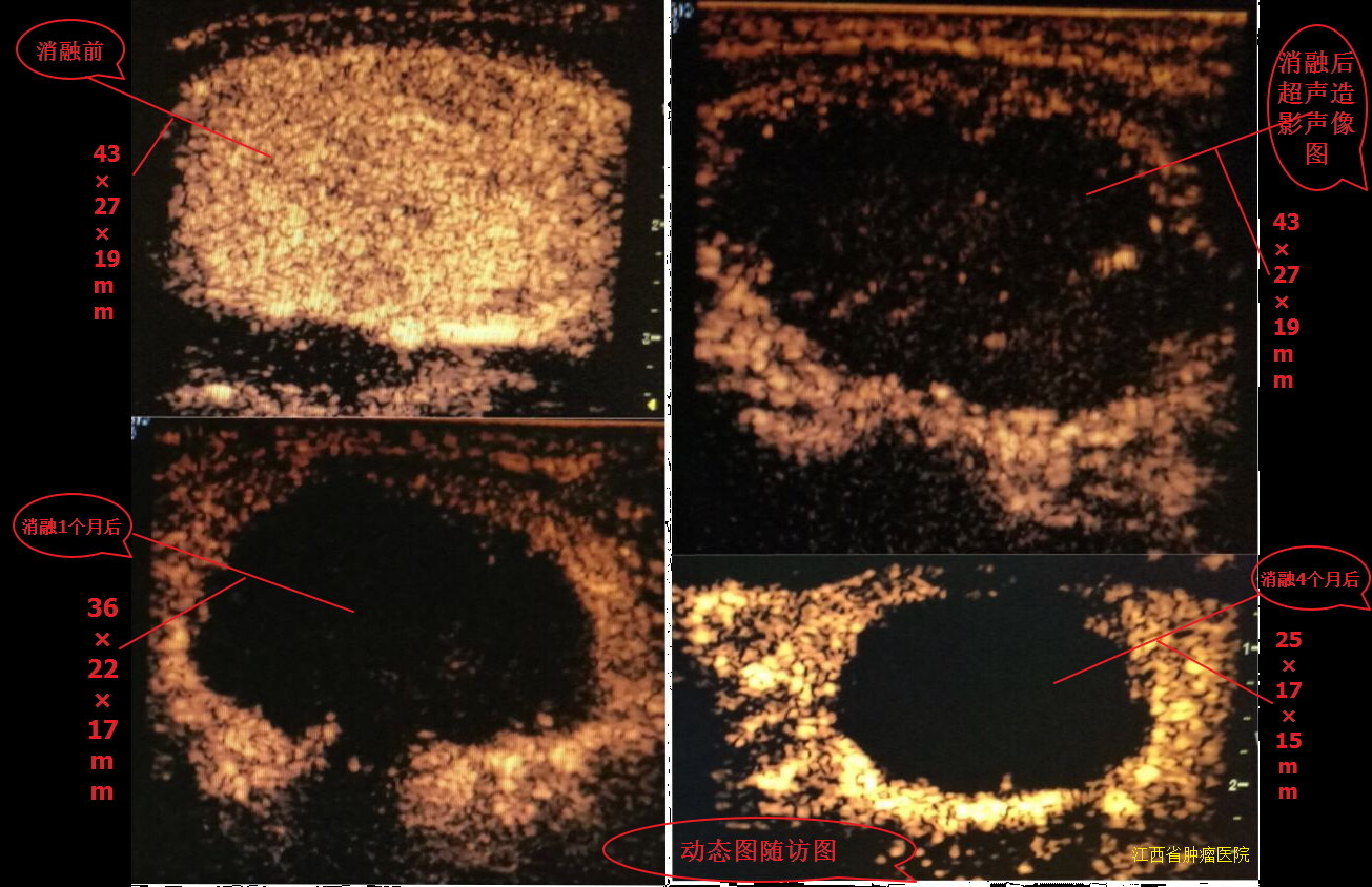 甲状腺结节微波消融术后,随访效果图!