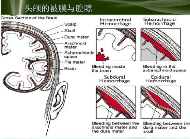 硬脑膜外血肿解剖图片