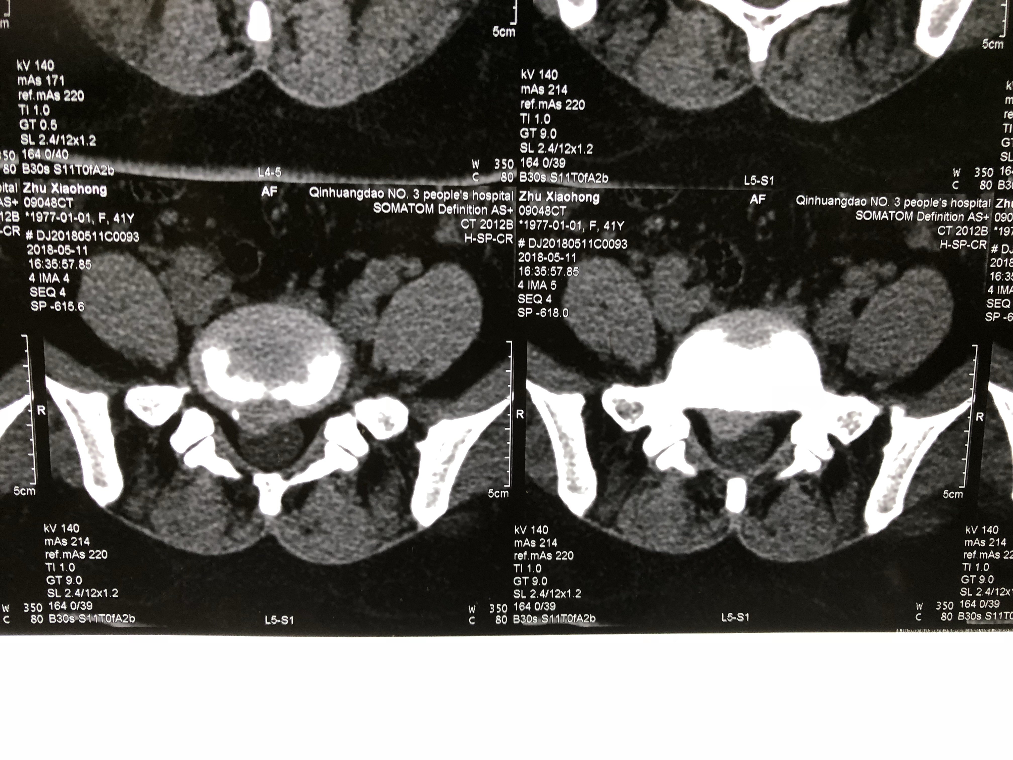 术前腰5骶1间盘突出ct术前核磁术前x线手术定位术中摘取椎间盘术后右