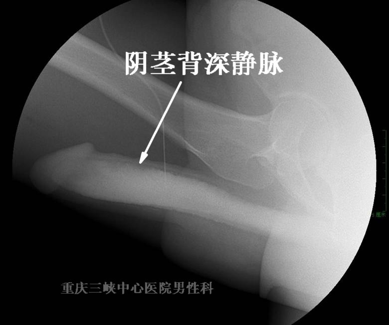 阴痉静脉纤维化图片