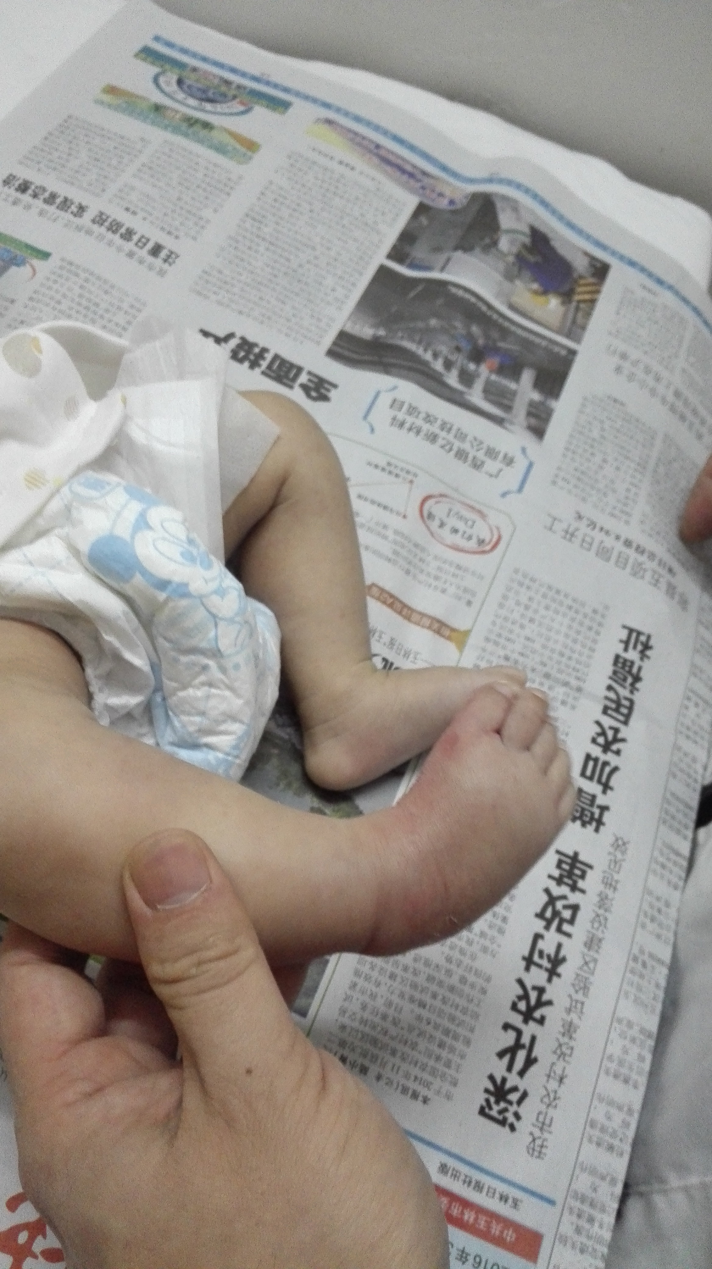四个月宝宝脚内翻图图片