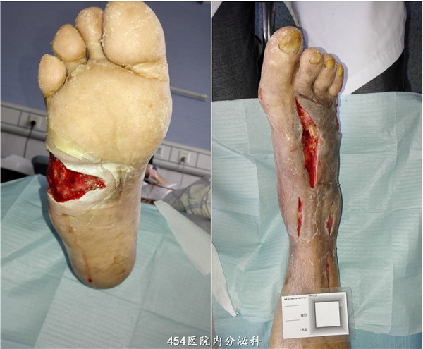 右足第5足趾外侧破溃愈合 - 好大夫在线