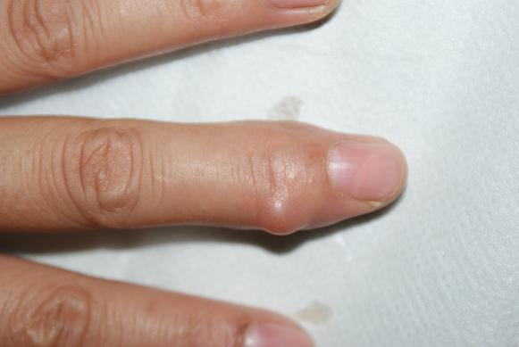 腱鞘巨细胞瘤 - 好大夫在线