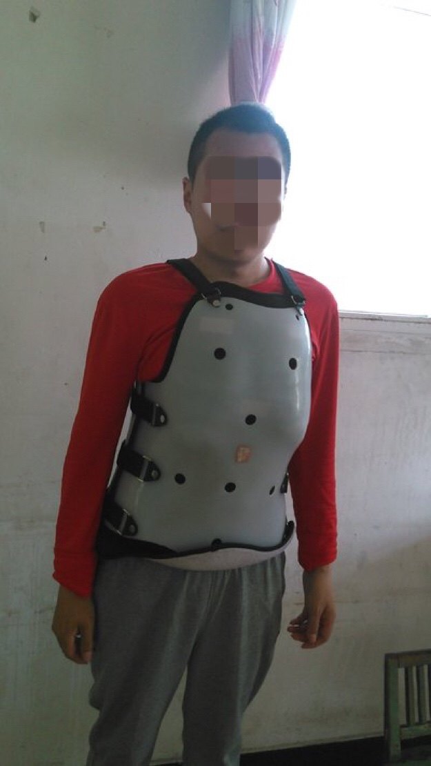 26年的脊柱侧弯"变形记"