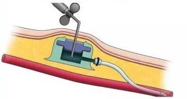 输液港结构图片