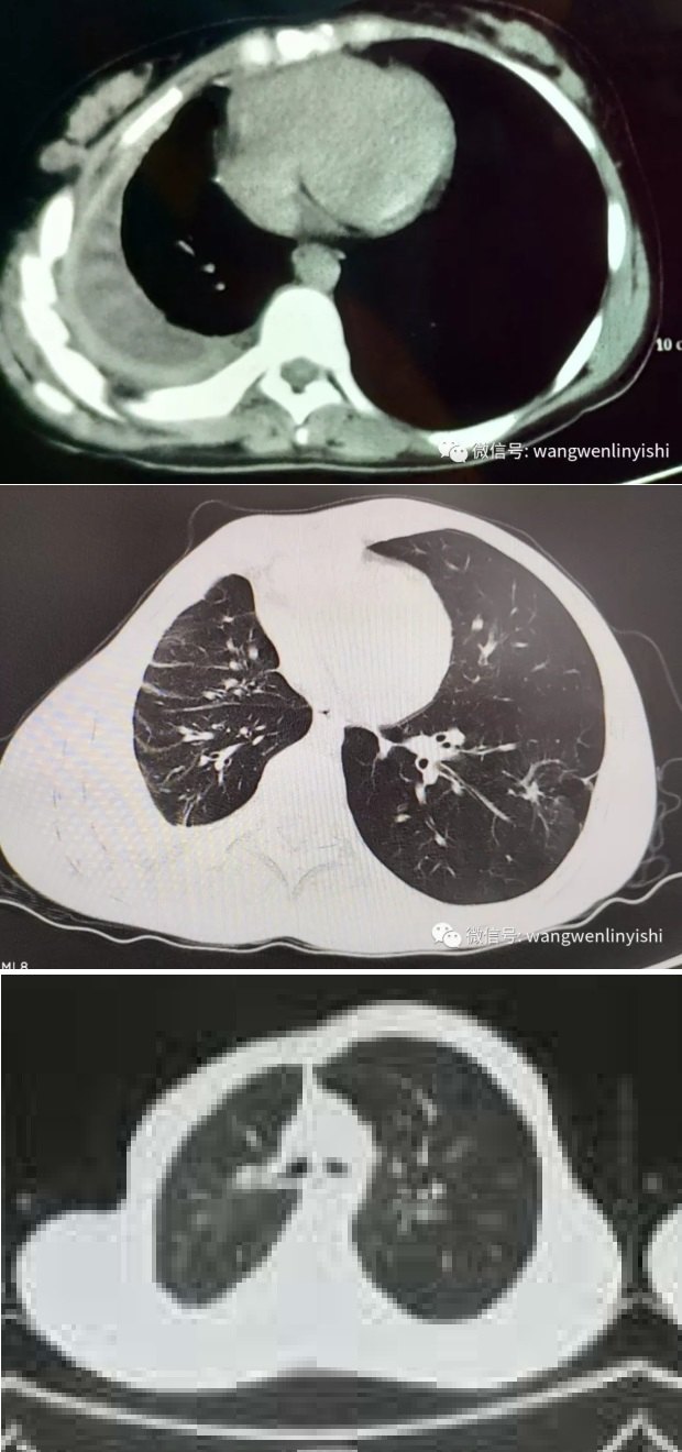 何建行教授與胸廓畸形手術的無管技術 - 好大夫在線