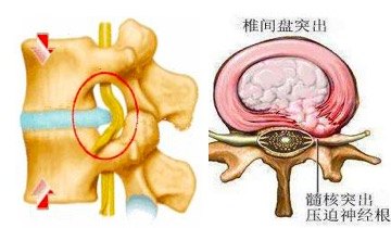 <!--HAODF:8:yaozhuijianpantuchu-->腰椎突出<!--HAODF:/8:yaozhuijianpantuchu-->1.jpg